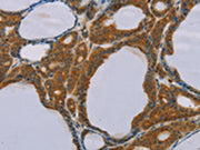 The image on the left is immunohistochemistry of paraffin-embedded Human thyroid cancer tissue using CSB-PA289634(PEF1 Antibody) at dilution 1/20, on the right is treated with fusion protein. (Original magnification: ×200)