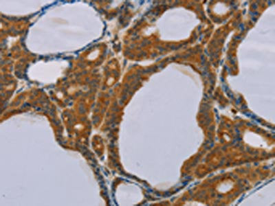 The image on the left is immunohistochemistry of paraffin-embedded Human thyroid cancer tissue using CSB-PA289634(PEF1 Antibody) at dilution 1/20, on the right is treated with fusion protein. (Original magnification: ×200)
