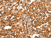 The image on the left is immunohistochemistry of paraffin-embedded Human thyroid cancer tissue using CSB-PA289766(CYP2B6 Antibody) at dilution 1/30, on the right is treated with synthetic peptide. (Original magnification: ×200)