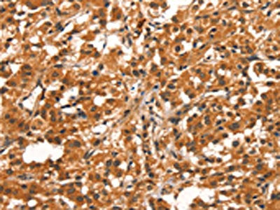 The image on the left is immunohistochemistry of paraffin-embedded Human thyroid cancer tissue using CSB-PA289766(CYP2B6 Antibody) at dilution 1/30, on the right is treated with synthetic peptide. (Original magnification: ×200)
