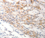 Immunohistochemical analysis of paraffin-embedded Human lung cancer tissue using at dilution 1/0.