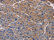 The image on the left is immunohistochemistry of paraffin-embedded Human liver cancer tissue using CSB-PA289822(NDUFA9 Antibody) at dilution 1/20, on the right is treated with fusion protein. (Original magnification: ×200)