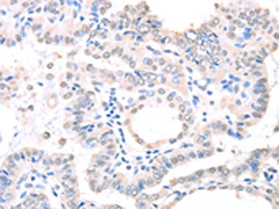 The image on the left is immunohistochemistry of paraffin-embedded Human thyroid cancer tissue using CSB-PA289847(APEX1 Antibody) at dilution 1/20, on the right is treated with fusion protein. (Original magnification: ×200)