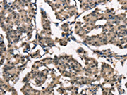 The image on the left is immunohistochemistry of paraffin-embedded Human breast cancer tissue using CSB-PA289915(NDNL2 Antibody) at dilution 1/40, on the right is treated with synthetic peptide. (Original magnification: ×200)