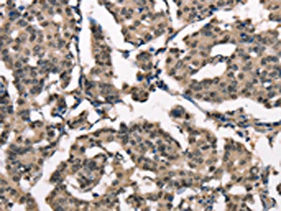 The image on the left is immunohistochemistry of paraffin-embedded Human breast cancer tissue using CSB-PA289915(NDNL2 Antibody) at dilution 1/40, on the right is treated with synthetic peptide. (Original magnification: ×200)