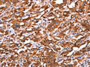 The image on the left is immunohistochemistry of paraffin-embedded Human thyroid cancer tissue using CSB-PA289923(GAS8 Antibody) at dilution 1/40, on the right is treated with synthetic peptide. (Original magnification: ×200)