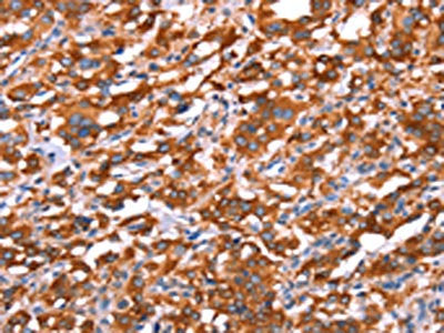 The image on the left is immunohistochemistry of paraffin-embedded Human thyroid cancer tissue using CSB-PA289923(GAS8 Antibody) at dilution 1/40, on the right is treated with synthetic peptide. (Original magnification: ×200)