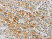 The image on the left is immunohistochemistry of paraffin-embedded Human liver cancer tissue using CSB-PA289963(ACSL4 Antibody) at dilution 1/25, on the right is treated with fusion protein. (Original magnification: ×200)