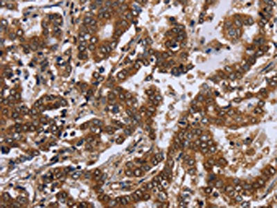 The image on the left is immunohistochemistry of paraffin-embedded Human liver cancer tissue using CSB-PA290047(FGF21 Antibody) at dilution 1/20, on the right is treated with fusion protein. (Original magnification: ×200)