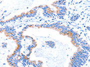 The image on the left is immunohistochemistry of paraffin-embedded Human colon cancer tissue using CSB-PA290049(SMG8 Antibody) at dilution 1/50, on the right is treated with synthetic peptide. (Original magnification: ×200)