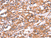 The image on the left is immunohistochemistry of paraffin-embedded Human thyroid cancer tissue using CSB-PA290137(GABBR1 Antibody) at dilution 1/30, on the right is treated with synthetic peptide. (Original magnification: ×200)