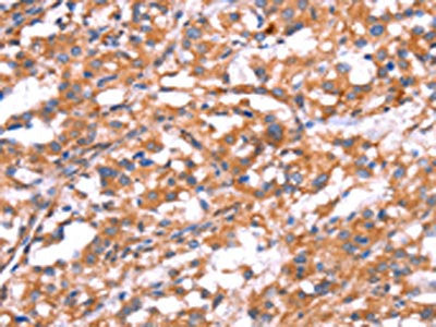 The image on the left is immunohistochemistry of paraffin-embedded Human thyroid cancer tissue using CSB-PA290137(GABBR1 Antibody) at dilution 1/30, on the right is treated with synthetic peptide. (Original magnification: ×200)