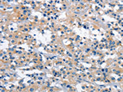 The image on the left is immunohistochemistry of paraffin-embedded Human thyroid cancer tissue using CSB-PA290331(GAS2 Antibody) at dilution 1/30, on the right is treated with fusion protein. (Original magnification: ×200)