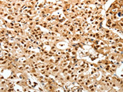 The image on the left is immunohistochemistry of paraffin-embedded Human ovarian cancer tissue using CSB-PA290377(TNXB Antibody) at dilution 1/30, on the right is treated with synthetic peptide. (Original magnification: ×200)