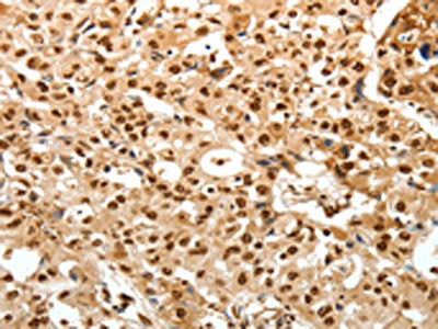 The image on the left is immunohistochemistry of paraffin-embedded Human ovarian cancer tissue using CSB-PA290377(TNXB Antibody) at dilution 1/30, on the right is treated with synthetic peptide. (Original magnification: ×200)