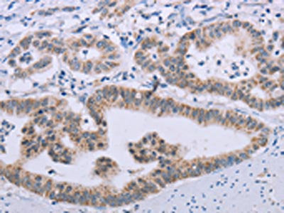 The image on the left is immunohistochemistry of paraffin-embedded Human gastic cancer tissue using CSB-PA290385(MRGPRX1 Antibody) at dilution 1/20, on the right is treated with synthetic peptide. (Original magnification: ×200)