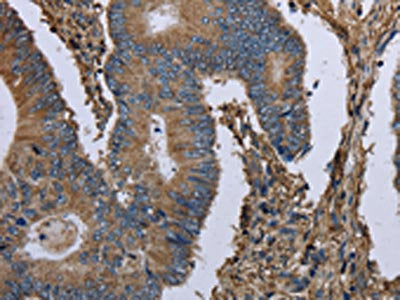 The image on the left is immunohistochemistry of paraffin-embedded Human colon cancer tissue using CSB-PA290508(MCM3AP Antibody) at dilution 1/30, on the right is treated with fusion protein. (Original magnification: ×200)