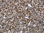 The image on the left is immunohistochemistry of paraffin-embedded Human prostate cancer tissue using CSB-PA290518(FAM89B Antibody) at dilution 1/30, on the right is treated with fusion protein. (Original magnification: ×200)