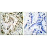 Immunohistochemical analysis of paraffin-embedded human lung carcinoma tissue using E2F4 antibody.