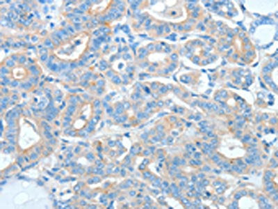 The image on the left is immunohistochemistry of paraffin-embedded Human thyroid cancer tissue using CSB-PA290707(AGO2 Antibody) at dilution 1/20, on the right is treated with fusion protein. (Original magnification: ×200)