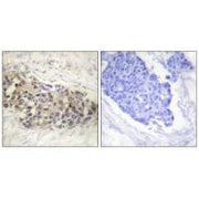 Immunohistochemistry analysis of paraffin-embedded human breast carcinoma tissue using USF2 antibody.