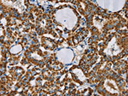 The image on the left is immunohistochemistry of paraffin-embedded Human thyroid cancer tissue using CSB-PA290810(CMC4 Antibody) at dilution 1/25, on the right is treated with fusion protein. (Original magnification: ×200)