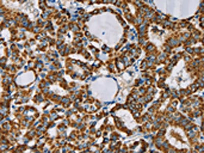The image on the left is immunohistochemistry of paraffin-embedded Human thyroid cancer tissue using CSB-PA290810(CMC4 Antibody) at dilution 1/25, on the right is treated with fusion protein. (Original magnification: ×200)