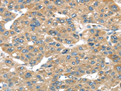 The image on the left is immunohistochemistry of paraffin-embedded Human liver cancer tissue using CSB-PA290881(TUSC1 Antibody) at dilution 1/45, on the right is treated with synthetic peptide. (Original magnification: ×200)