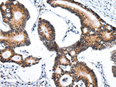 The image on the left is immunohistochemistry of paraffin-embedded Human tonsil tissue using CSB-PA290957(ZNF473 Antibody) at dilution 1/30, on the right is treated with synthetic peptide. (Original magnification: ×200)