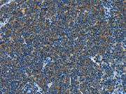 The image on the left is immunohistochemistry of paraffin-embedded Human Lymphoma tissue using CSB-PA291126(CNTNAP3 Antibody) at dilution 1/40, on the right is treated with synthetic peptide. (Original magnification: ×200)