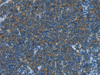 The image on the left is immunohistochemistry of paraffin-embedded Human Lymphoma tissue using CSB-PA291126(CNTNAP3 Antibody) at dilution 1/40, on the right is treated with synthetic peptide. (Original magnification: ×200)