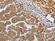 The image on the left is immunohistochemistry of paraffin-embedded Human liver cancer tissue using CSB-PA291244(CASP12 Antibody) at dilution 1/50, on the right is treated with synthetic peptide. (Original magnification: ×200)