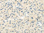 The image on the left is immunohistochemistry of paraffin-embedded Human liver cancer tissue using CSB-PA291346(VIPR1 Antibody) at dilution 1/20, on the right is treated with synthetic peptide. (Original magnification: ×200)