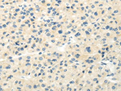 The image on the left is immunohistochemistry of paraffin-embedded Human liver cancer tissue using CSB-PA291346(VIPR1 Antibody) at dilution 1/20, on the right is treated with synthetic peptide. (Original magnification: ×200)