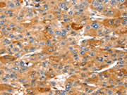 The image on the left is immunohistochemistry of paraffin-embedded Human liver cancer tissue using CSB-PA291750(STK33 Antibody) at dilution 1/30, on the right is treated with fusion protein. (Original magnification: ×200)