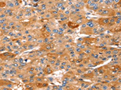 The image on the left is immunohistochemistry of paraffin-embedded Human liver cancer tissue using CSB-PA291750(STK33 Antibody) at dilution 1/30, on the right is treated with fusion protein. (Original magnification: ×200)