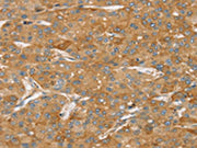 The image on the left is immunohistochemistry of paraffin-embedded Human liver cancer tissue using CSB-PA291759(TPD52L2 Antibody) at dilution 1/35, on the right is treated with synthetic peptide. (Original magnification: ×200)