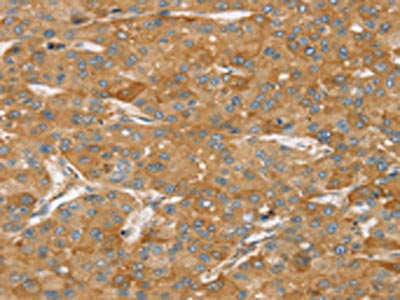 The image on the left is immunohistochemistry of paraffin-embedded Human liver cancer tissue using CSB-PA291759(TPD52L2 Antibody) at dilution 1/35, on the right is treated with synthetic peptide. (Original magnification: ×200)