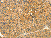 The image on the left is immunohistochemistry of paraffin-embedded Human lung cancer tissue using CSB-PA291799(PRKACG Antibody) at dilution 1/25, on the right is treated with fusion protein. (Original magnification: ×200)
