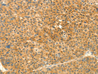 The image on the left is immunohistochemistry of paraffin-embedded Human lung cancer tissue using CSB-PA291799(PRKACG Antibody) at dilution 1/25, on the right is treated with fusion protein. (Original magnification: ×200)