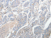 The image on the left is immunohistochemistry of paraffin-embedded Human lung cancer tissue using CSB-PA291867(FOXD1 Antibody) at dilution 1/25, on the right is treated with synthetic peptide. (Original magnification: ×200)