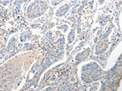 The image on the left is immunohistochemistry of paraffin-embedded Human lung cancer tissue using CSB-PA291867(FOXD1 Antibody) at dilution 1/25, on the right is treated with synthetic peptide. (Original magnification: ×200)