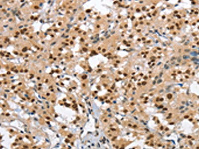 The image on the left is immunohistochemistry of paraffin-embedded Human thyroid cancer tissue using CSB-PA291895(GTF2I Antibody) at dilution 1/40, on the right is treated with synthetic peptide. (Original magnification: ×200)
