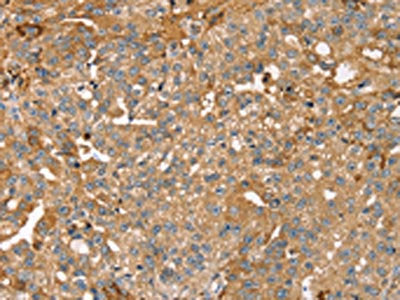 The image on the left is immunohistochemistry of paraffin-embedded Human breast cancer tissue using CSB-PA291923(ROBO3 Antibody) at dilution 1/25, on the right is treated with fusion protein. (Original magnification: ×200)