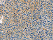 The image on the left is immunohistochemistry of paraffin-embedded Human liver cancer tissue using CSB-PA291937(BRCA1 Antibody) at dilution 1/35, on the right is treated with fusion protein. (Original magnification: ×200)