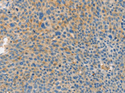 The image on the left is immunohistochemistry of paraffin-embedded Human liver cancer tissue using CSB-PA291937(BRCA1 Antibody) at dilution 1/35, on the right is treated with fusion protein. (Original magnification: ×200)