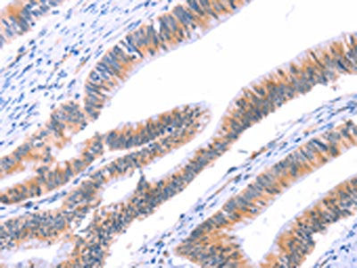 The image on the left is immunohistochemistry of paraffin-embedded Human colon cancer tissue using CSB-PA292051(VWF Antibody) at dilution 1/50, on the right is treated with fusion protein. (Original magnification: ×200)
