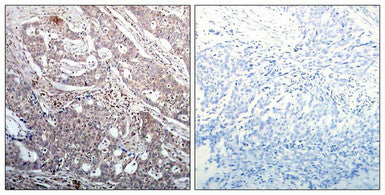 Immunohistochemical analysis of paraffin-embedded human breast carcinoma tissue using IkB-b(Phospho-Ser23) Antibody(left) or the same antibody preincubated with blocking peptide(right).