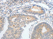The image on the left is immunohistochemistry of paraffin-embedded Human colon cancer tissue using CSB-PA292099(CALCR Antibody) at dilution 1/25, on the right is treated with fusion protein. (Original magnification: ×200)