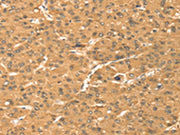 The image on the left is immunohistochemistry of paraffin-embedded Human liver cancer tissue using CSB-PA292200(TMEM123 Antibody) at dilution 1/25, on the right is treated with fusion protein. (Original magnification: ×200)